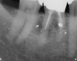 root canal treatment