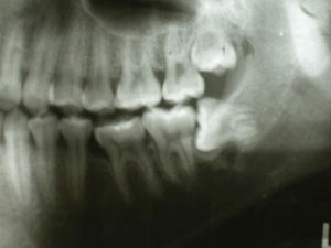 wisdom teeth removal auckland